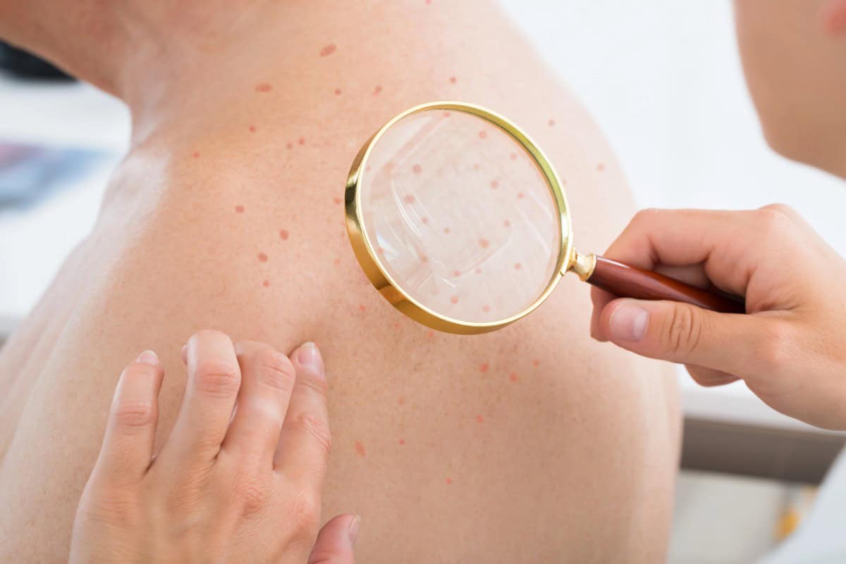 Hautcheck beim Dermatologen